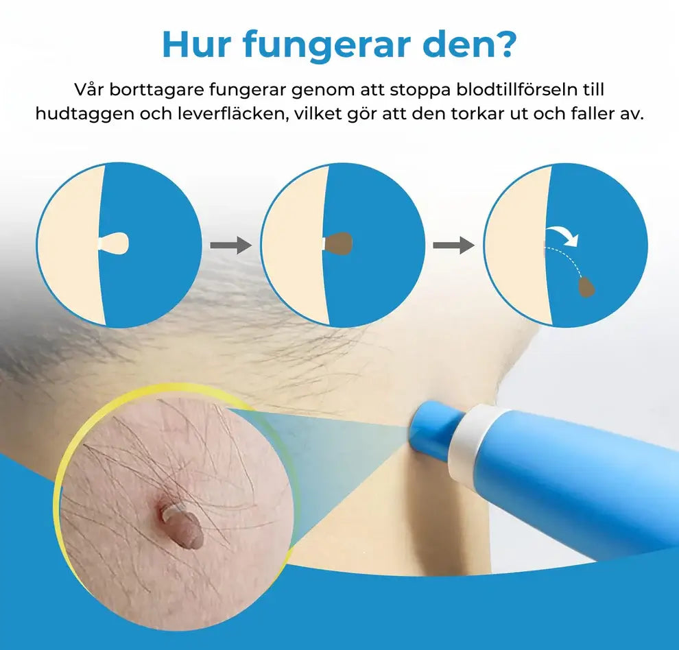 Leverfläcksborttagning & Hudflikborttagningskit – Enkel och Naturlig Behandling Hemma